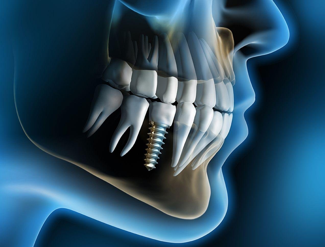 Dental implants