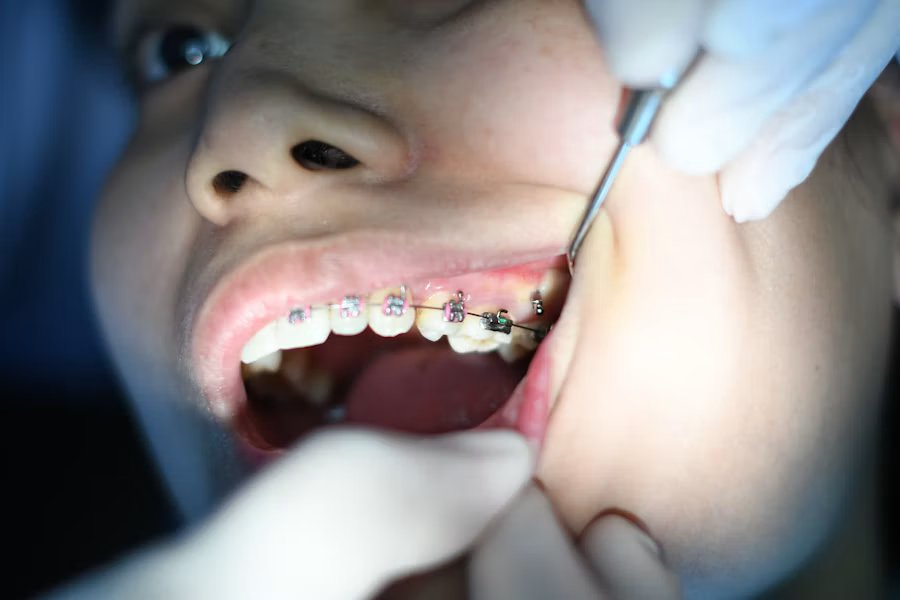 Orthodontics at Ivory Dental Payyanur